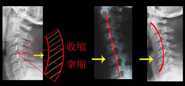 针刀操作技巧 初学者必看