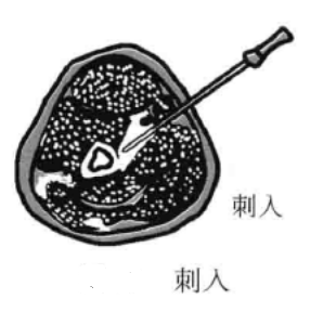 针刀操作技巧 初学者必看