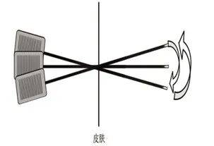 针刀操作技巧 初学者必看