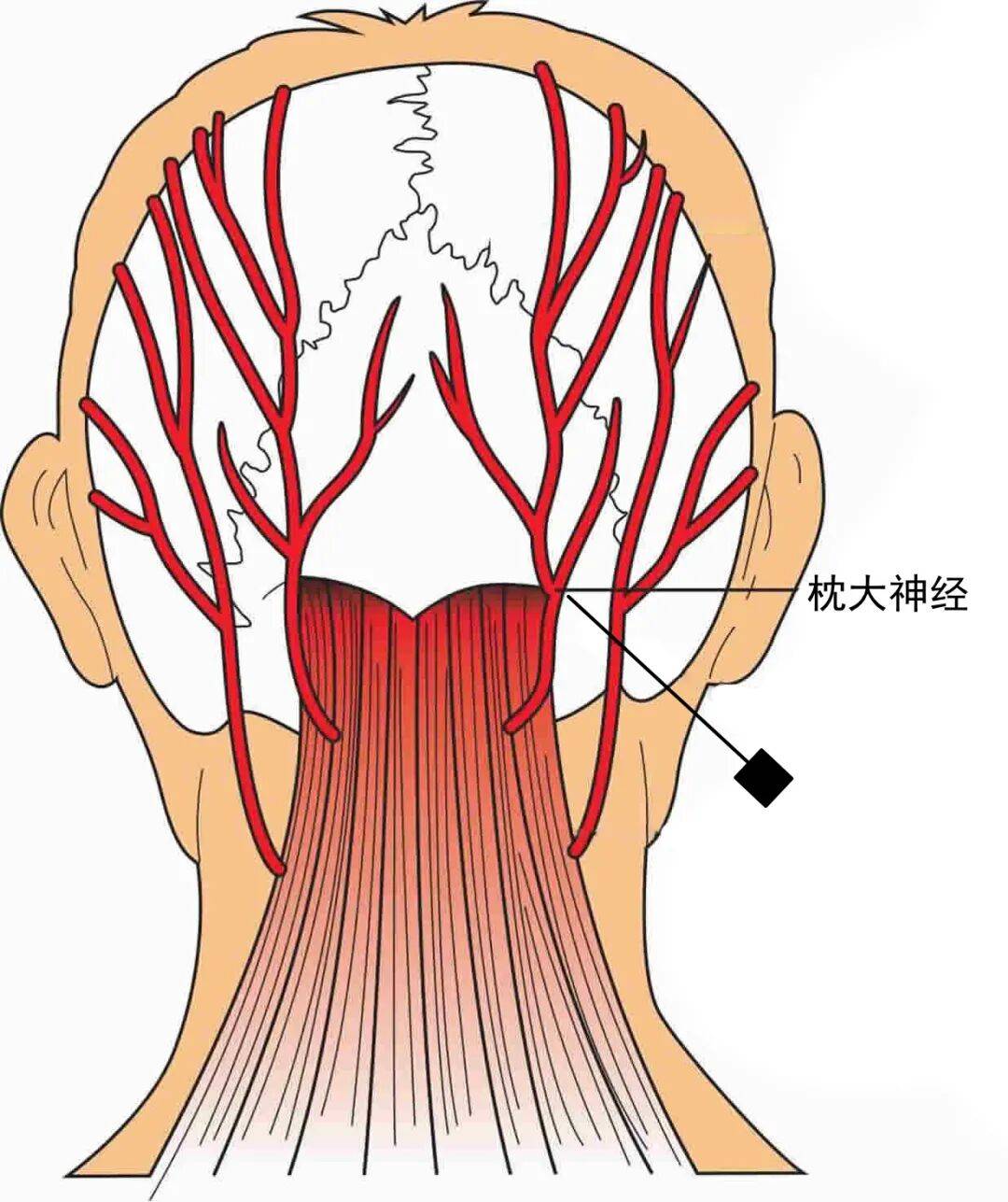 针刀操作技巧 初学者必看