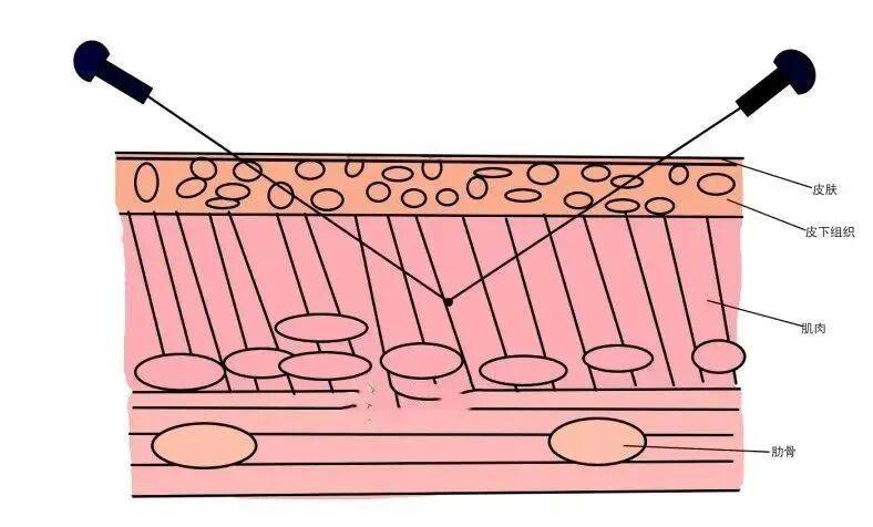 针刀操作技巧 初学者必看